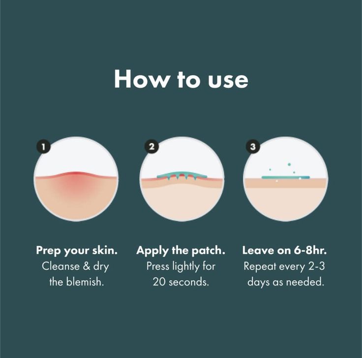 Acne patch